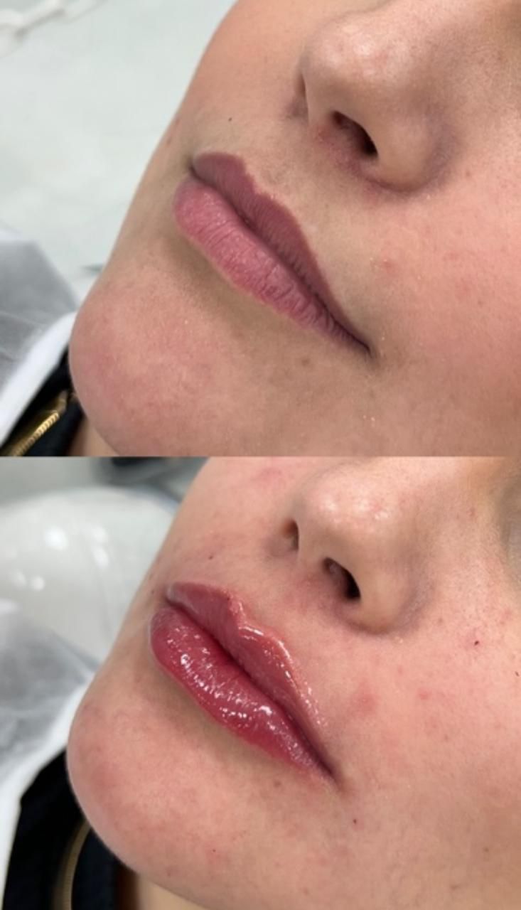 Preenchimento Facial